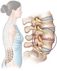Illustration of the spine with a magnified spinal disc and nearby nerves.