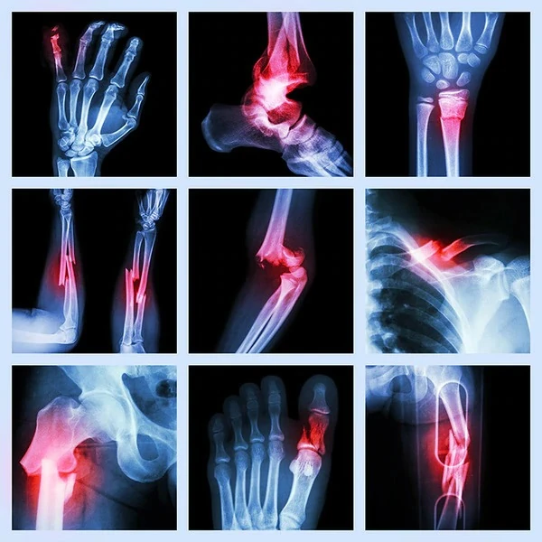 Educational collage illustrating fractures in different bones.