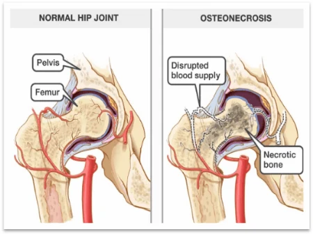 Diagram comparing a normal hip with osteonecrosis caused by disrupted blood supply.