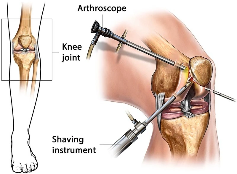 Illustration of knee arthroscopy showing an arthroscope and a surgical instrument.