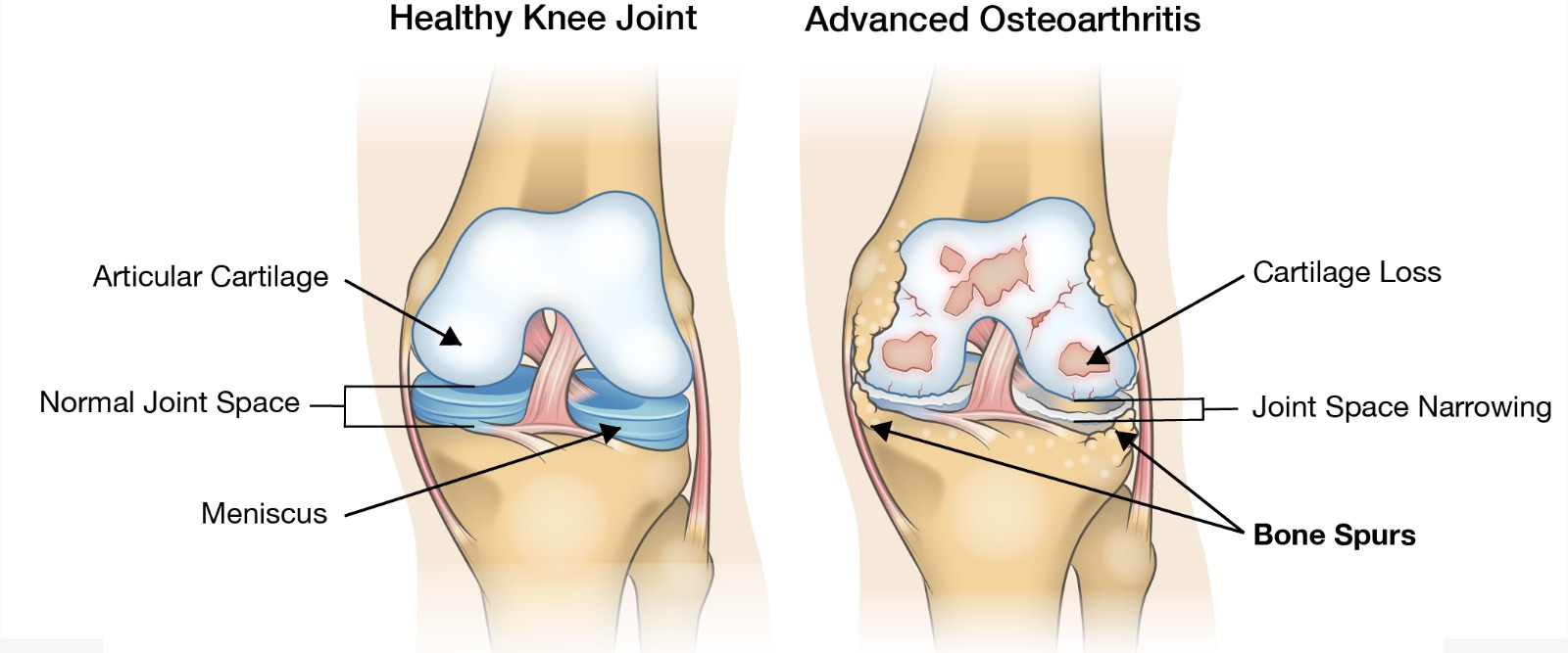 Healthy knee and advanced osteoarthritis, showing cartilage loss, joint-space narrowing and bone spurs.
