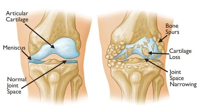 Diagram comparing a healthy knee with a knee affected by osteoarthritis.