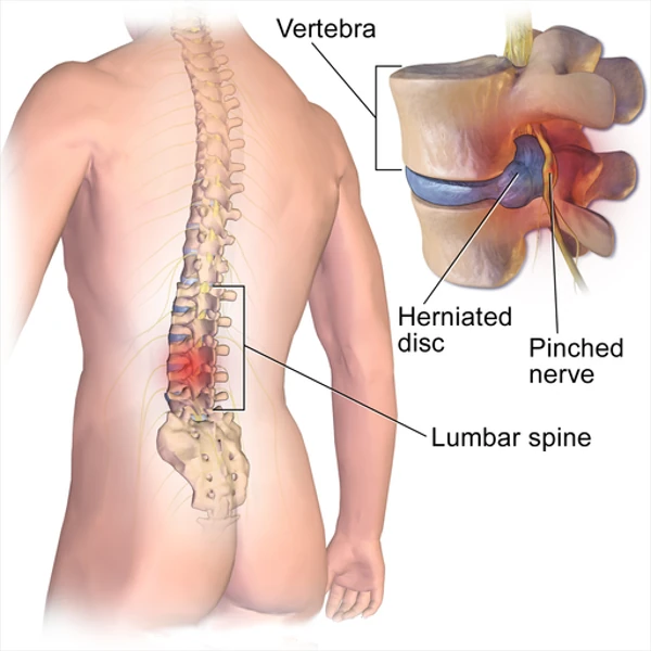Illustration of a lumbar herniated disc pressing on a nearby nerve.