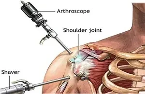 Illustration of a shoulder joint with an arthroscope and a shaver instrument.