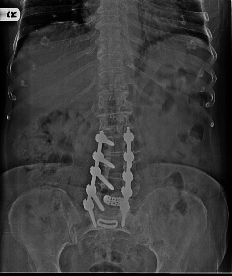 Front-view spinal X-ray showing fixation hardware.