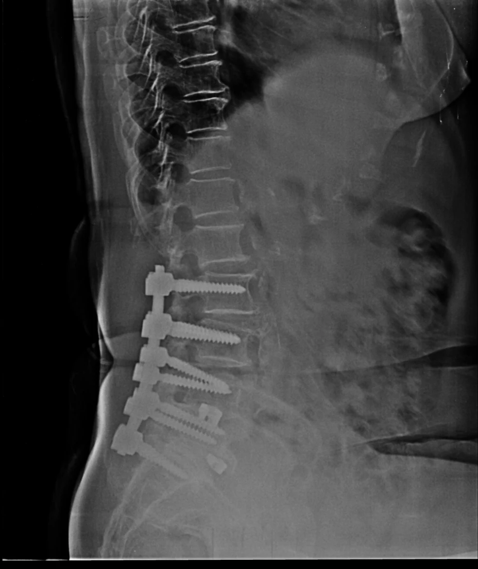 Side-view spinal X-ray showing fixation hardware.